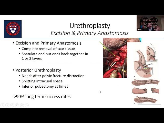 IVUmed & St. Lucia: Urethral Strictures and Urethral Reconstruction