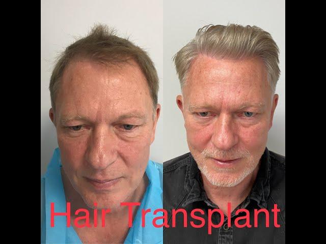 hair transplant results after two years Conor Mullen. FUE + FUT