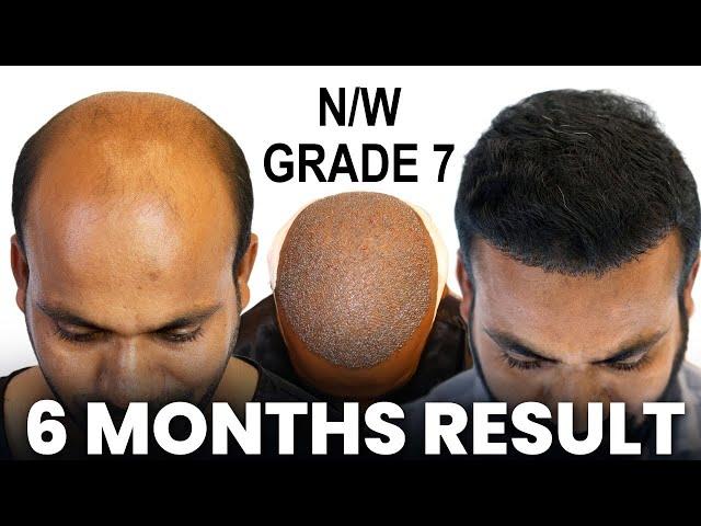 Grade 7 Hair Transplant Result India | 6000 Grafts |