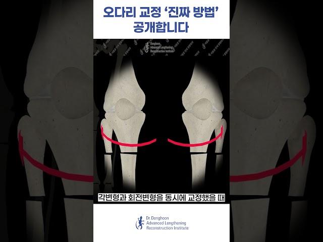 오다리 교정 수술은 이렇게 하시면 안 됩니다 #오다리 #오다리교정 #shorts #fyp #관절염