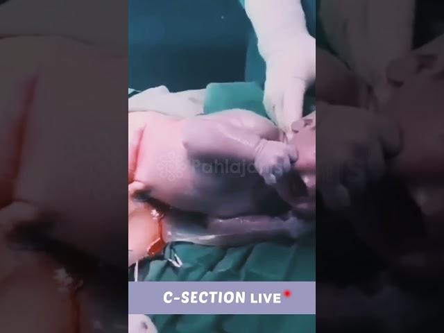 LIVE C-Section (Cesarean Delivery) | ऐसा सिज़ैरीअन डिलीवेरी नहीं देखा होगा! 🫢 #baby #csectionmom