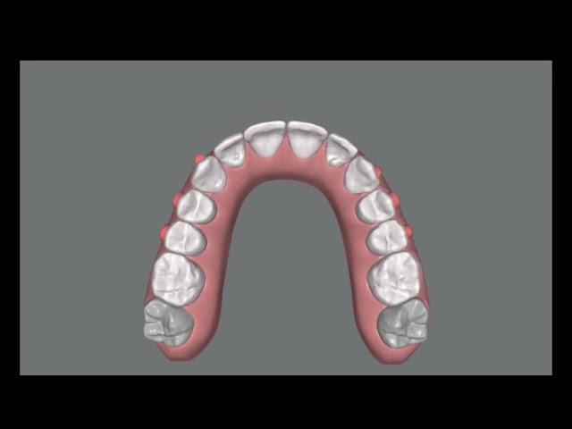 Simple alignment with Invisalign. clincheck project ready to send to the patient.