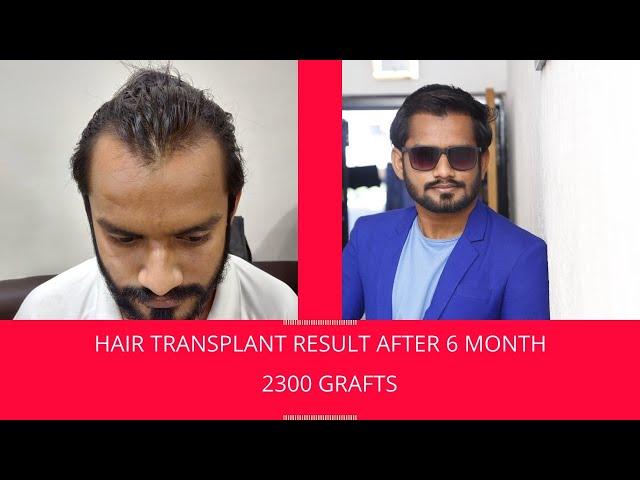 Hair Transplant Result 2021 || NW Grade2||  2300 Grafts|| Hair Transplant Clinic