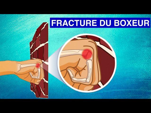 FRACTURE DU CINQUIÈME MÉTACARPIEN (Fracture du boxeur) : Diagnostic et Traitements