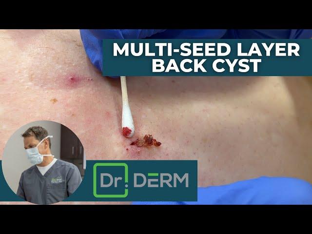 Multi-Seed Layer Back Cyst | Dr. Derm