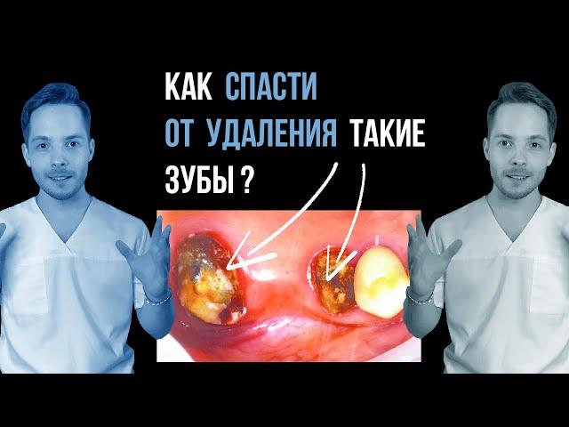 Как спасти сильно разрушившиеся зубыСлучай из врачебной практики.