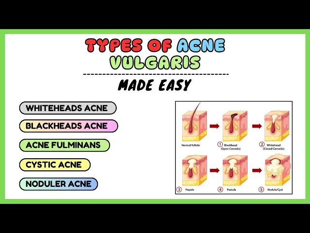 Acne vulgaris, types of acne, acne types and treatment, dermatology made simple