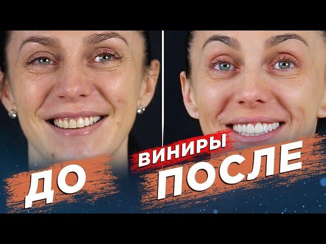 Керамические виниры. Виниры ДО И ПОСЛЕ. Ceramic veneers