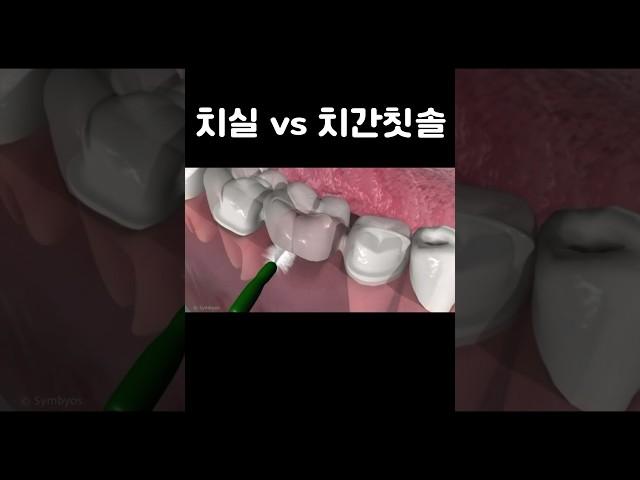 치실 vs 치간칫솔ㅣ치과의사의 선택은?