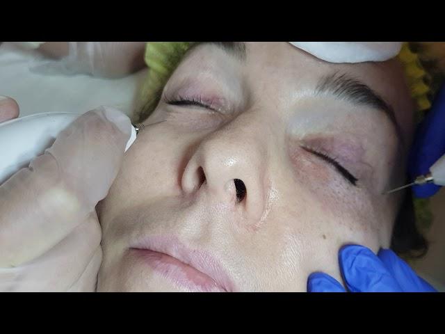 53 PLASMA PEN (ПЛАЗМА ПЕН) ОБУЧЕНИЕ МОСКВА - Курс ведет Врач дерматолог-косметолог Хуснутдинова Н.В.