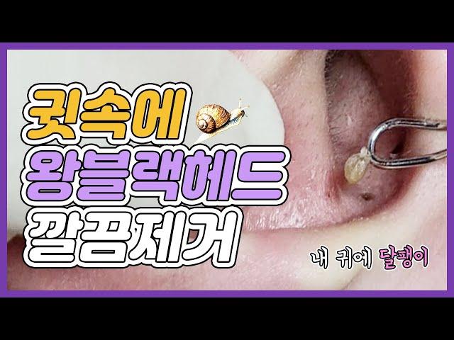 속 시원한 귀 피지 제거, 대왕 블랙헤드가 쏙쏙 나오는 영상 Giant blackhead in ear, blackhead removal