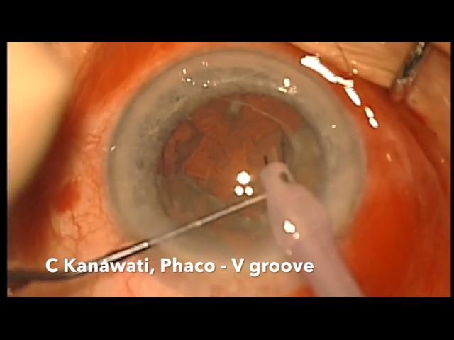 Routine Phaco for hard nucleus/Kelman victory/v-groove technique