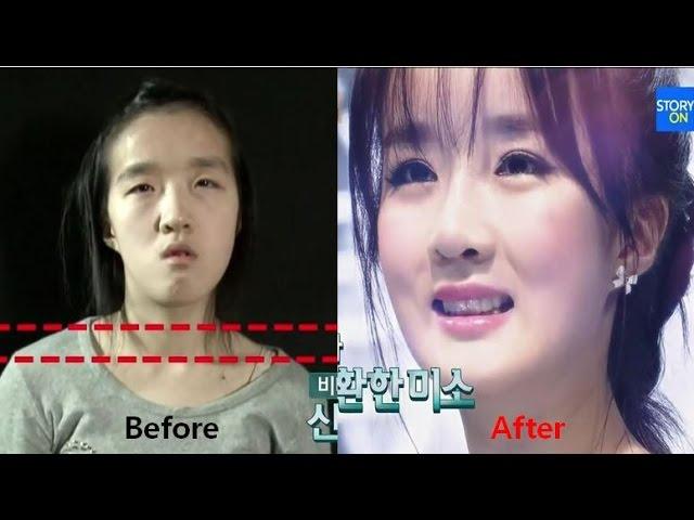 LET ME IN 5 Mommy make over to a doll (Korean Plastic Surgery Before & After, Jaw Surgery)