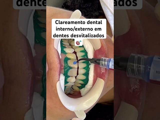 Clareamento dental em dentes desvitalizados  #dentes #dentistas #clareamentodental #odonto