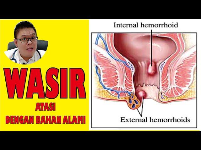 WASIR /AMBEIEN........... GUNAKAN BAHAN-BAHAN ALAMI INI