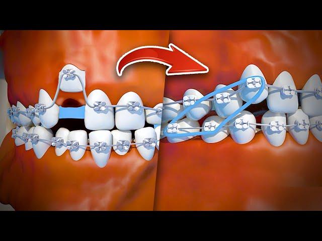 How braces are put on - Step by step