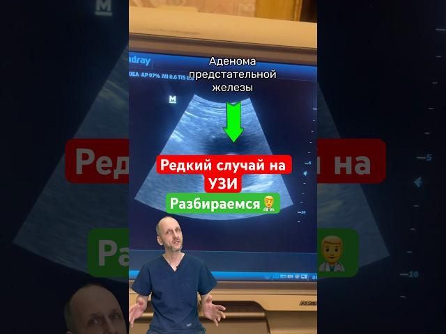 Редкий случай | Мочевой пузырь узи с рассказом #доктор #узи #топ #онкология #рассказ