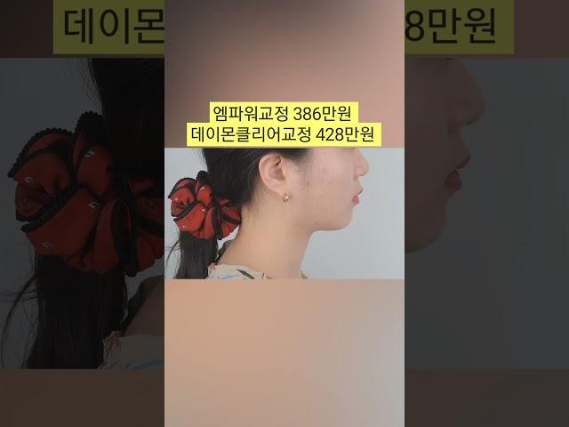 #돌출입교정. 서울대교정과전문의에게 치료받는 돌출입교정 (02 2676 2877 가이교정치과) #치아교정 #치아교정치과 #돌출입교정 #치아교정비용