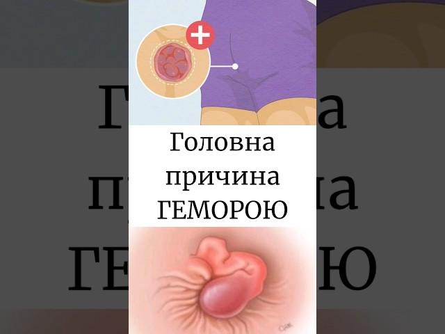 Геморой, причина та як його запобігти