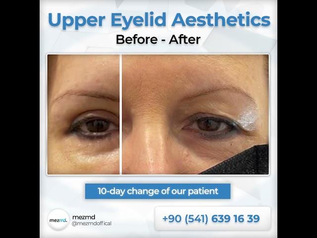 Upper Eyelied (Blepharoplasty) Surgery - Before & After | mezMD Health Tourism Agency