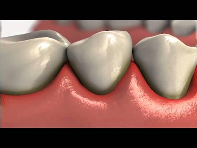 Understanding Gum Disease From Colgate