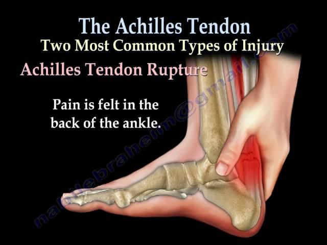 Achilles Tendon rupture ,tear, tendonitis - Everything You Need To Know - Dr. Nabil Ebraheim