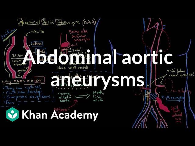 Abdominal aortic aneurysms | Circulatory System and Disease | NCLEX-RN | Khan Academy