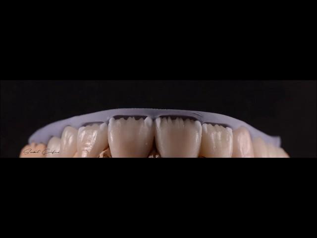 IPS E.max ceram porcelain minimal Build up , e.max CAD , e.max cut-back