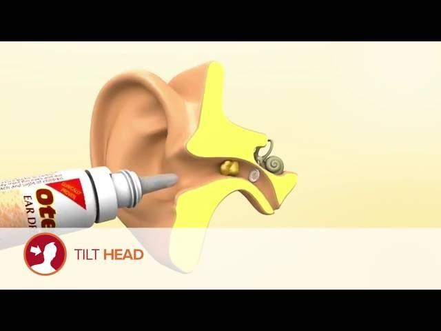 How to use Otex Ear Drops