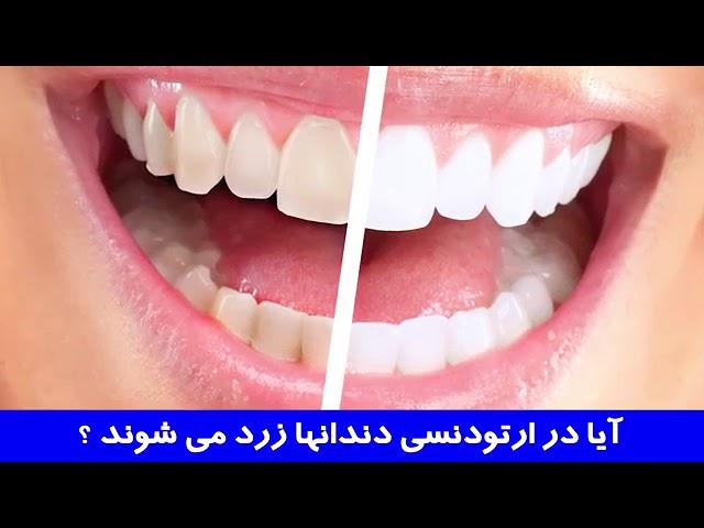 آیا در ارتودنسی دندانها زرد می شوند؟ | دکتر احسان مهریزی