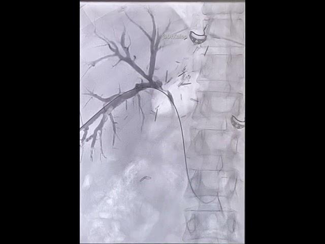 Post Anastomotic Biliary Stricture. Cholangiogram done during PTBD.