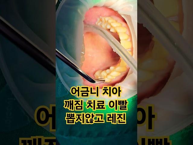 어금니 치아 깨짐 치료 이빨 뽑지 않고 레진 및 인레이 프렙 inlay prep