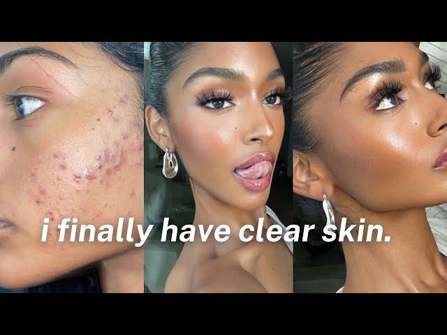 SKINCARE ROUTINE | MELANIN FRIENDLY! HOW I CLEARED HORMONAL ACNE & HYPERPIGMENTATION 