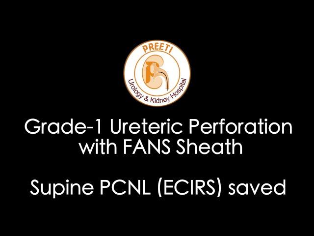 Grade-1 Ureteric Perforation with FANS Sheath - Supine PCNL (ECIRS) saved