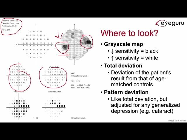 7.2 - Humphrey Visual Field