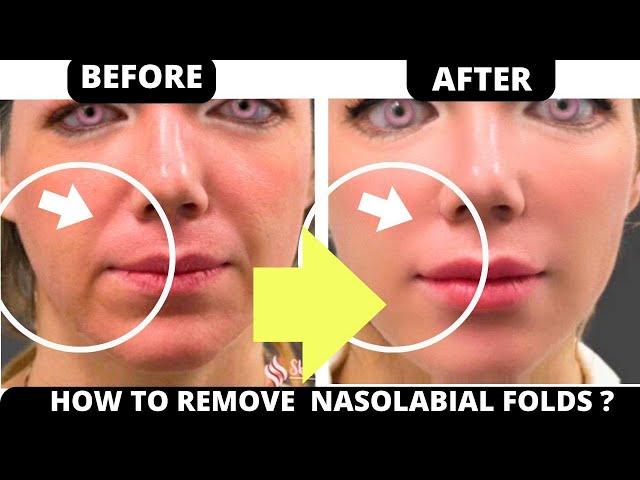 HOW TO GET RID OF NASOLABIAL FOLDS WITH FACE YOGA ? LAUGH LINES / SMILE LINES | NATURALLY