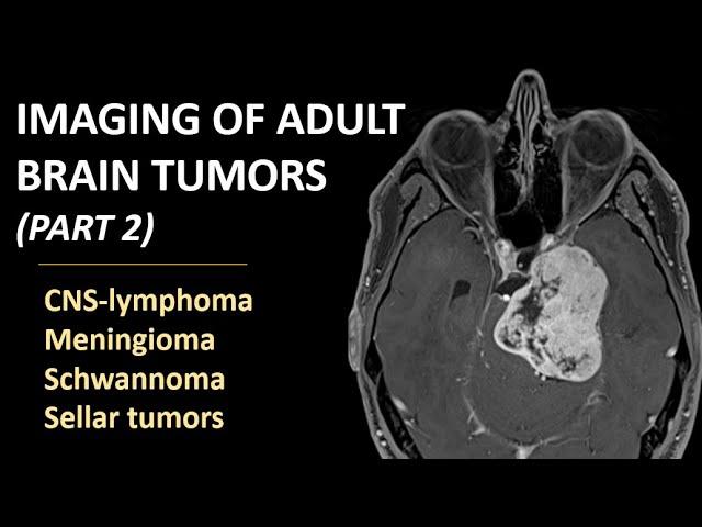 Imaging of brain tumors (part 2): CNS-lymphoma, meningioma, schwannoma and sellar tumors