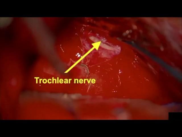 Gross Total Resection of Large CP Angle Meningioma with Suprameatal Drilling & Tentorial Sectioning