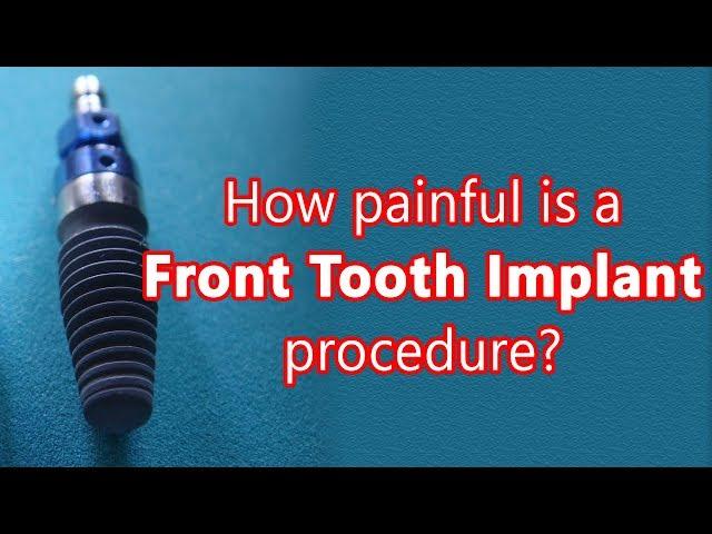 Front tooth implant procedure and how painful it is? - Dr. Muddugangadhar B C