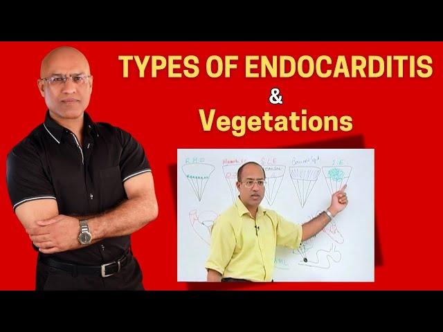 Endocarditis Types and Vegetations | Cardiology🫀