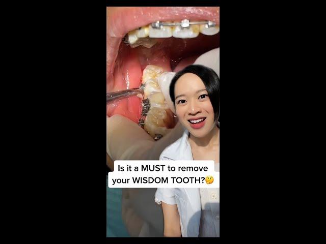 MUST you extract your Wisdom Tooth?  Here's the answer!  #shorts