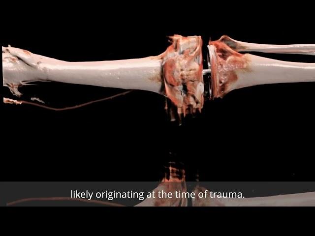 Anatomage Table Patient Case 184 - Knee Replacements and Amputation