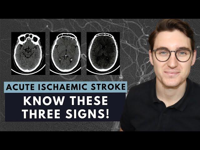 How to read a CT brain scan: Acute ischaemic stroke for beginners