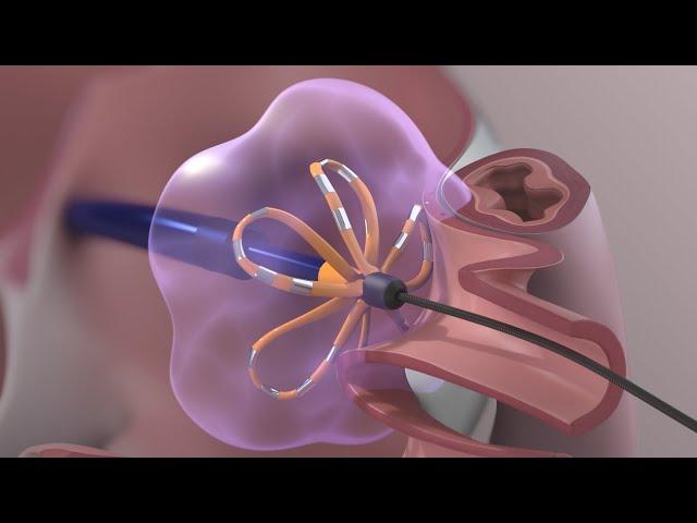 Medical Device Animation: Atrial Fibrillation Ablation Surgery