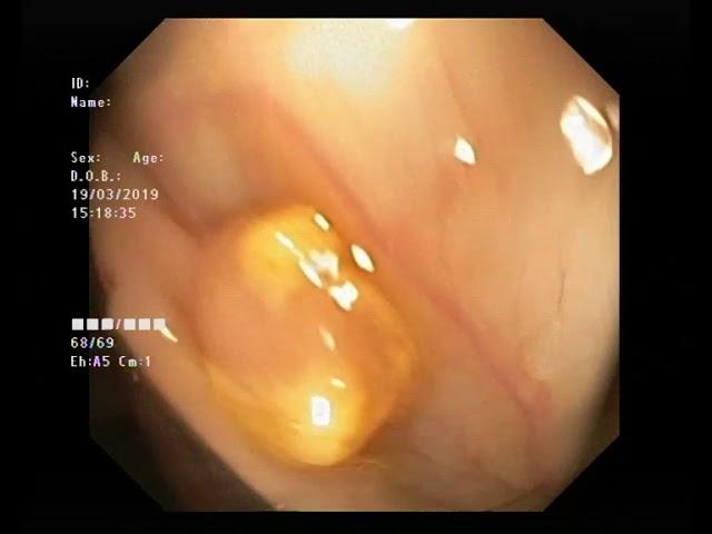 Polypectomy from descendens colon colonoscopy