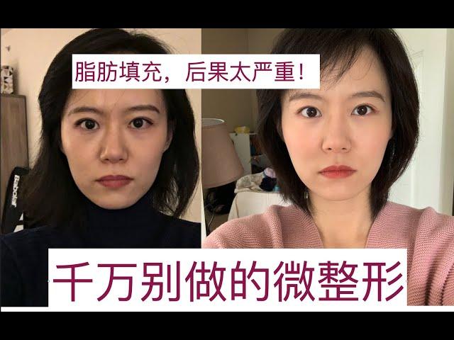 【险些毁容】最后怕的微整形项目是什么？年轻不懂事，变美的代价太大。大家千万不要做！