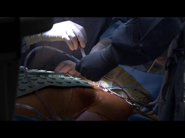 Bypass Surgery side view - Infuse Medical