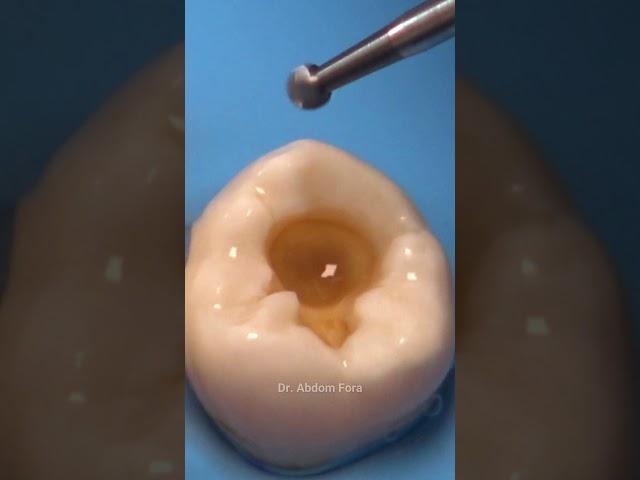 Cavity teeth treatment video #satisfying