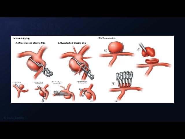 Pterional Craniotomy for Clip Reconstruction of a Dolichoectatic Middle Cerebral Artery Aneurysm