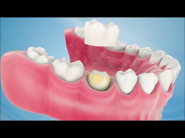 Dental Crown Procedure